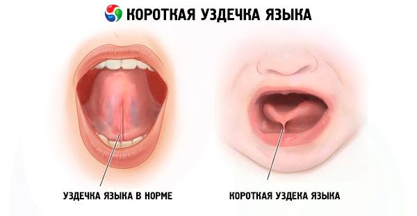 Короткая уздечка языка у новорожденного ребенка и взрослого 2046